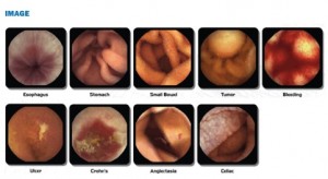 endoscopy after effects