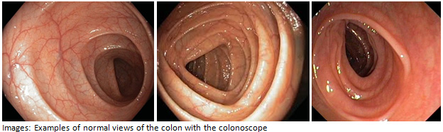 Colonoscopy