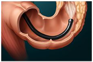 crohn’s disease