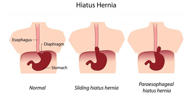 Gastro-Oesophageal Reflux Disease Capel Sound | GORD Rosebud