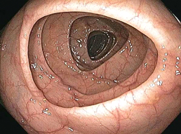 Colonoscopy of ulcerative colitis and bowel inflammation