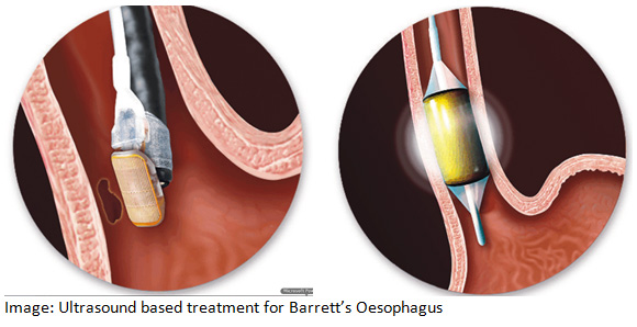 Barrett’s Oesophagus Treatment Mornington Peninsula  Capel Sound, Rosebud