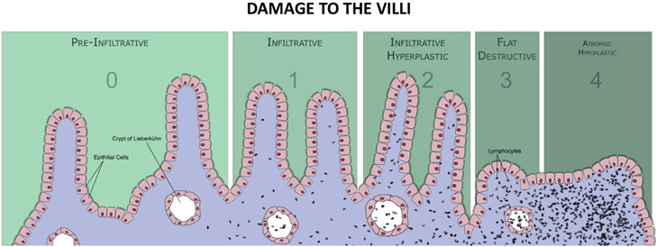 celiac disease histology